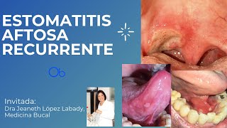 Estomatitis aftosa recurrente 👄 👅 [upl. by Sahc]