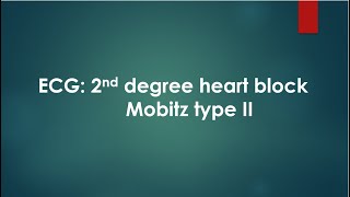 ECG 2nd degree heart block Mobitz type II [upl. by Sutelc]