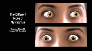 Types of Nystagmus Due to BPPV Vertigo What it Looks Like Which Side amp Which Maneuver [upl. by Annahsat]