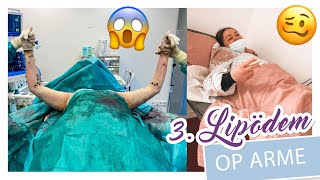 3 LIPÖDEM OPERATION  ARME  Erste VOLLNARKOSE Liposuktion Heilung Kosten etc  YooNessa [upl. by Lertnom]