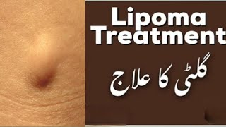 lipoma TREATMENT [upl. by Ekenna]