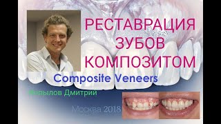 Композитные виниры Трансформация клыков в резцы Виниры до и после Composite veneers [upl. by Oynotna867]