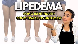 COMO IDENTIFICAR E TRATAR LIPEDEMA [upl. by Okimik]