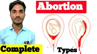 A B O R T I O N  Types Cause Symptoms Diagnosis Treatment  Abortion in Hindi  Types of Abortion [upl. by Flemming]