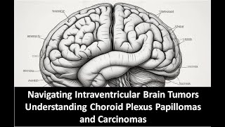 Navigating Intraventricular Brain Tumors Understanding Choroid Plexus Papillomas and Carcinomas [upl. by Hgielhsa]