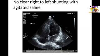 Atrial Septal Defect  ASD  Pediatrics cardiology  شرح بالعربي [upl. by Olotrab995]