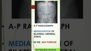 Spotter prepladder radiology radiologyresident neetpg neetpreparation marrow shortvideo [upl. by Nilad]