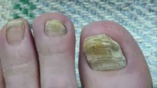 Toe Nail Fungus Cure 30 Months Progress [upl. by Elenaj94]