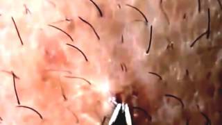 13 ingrown hair removal compilation vol 1 YouTube [upl. by Ititrefen]