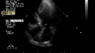 LV apical cystic thrombus 22 [upl. by Nevear166]