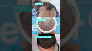 Scott Quigg Post OP 12 months FUE hair transplant at the Hair Dr Clinic [upl. by Ajnat]