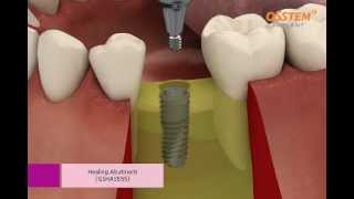 OSSTEM IMPLANT TSIII System Surgical Procedure Taper Kit and Straight Drill Kit [upl. by Lilith]