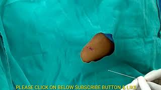 Lumbar Puncture Procedure in Hindi spinal tap diagnostic Procedure [upl. by Bibah]