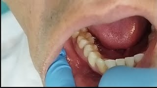 Dolor del diente después de un tratamiento de conducto Endodoncia por qué me duele el diente [upl. by Bancroft]