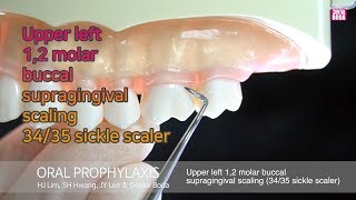 Upper left 12 molar buccal supragingival scaling 3435 sickle scaler [upl. by Leirol]