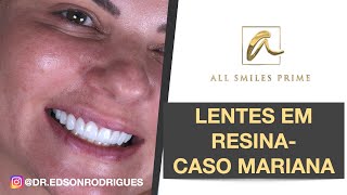 Lentes de Resina  Caso Mariana [upl. by Alaet]