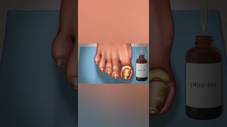 ASMR Footcare Video  Ingrown Toe Nail  Satisfying Asmrvidz007 youtube shorts [upl. by Mathew]