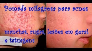 EFEDERMCOMO TIRAR MANCHAS DA PELE pomada milagrosa acnes manchas rugas olheiras ETC [upl. by Ettenoj395]