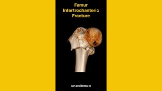 Femur Intertrochanteric Fracture [upl. by Annahsal464]