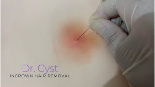 Ingrown Hair Removal ASMR [upl. by Ynelram453]