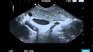 Endosonography in Autoimmune Pancreatitis [upl. by Iruj]