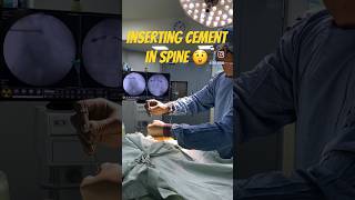 Watch this 👉 Inserting Cement in Spine 😮 Vertebroplasty [upl. by Barden]