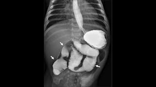 BARIUM MEAL procedure By ZAMZAM DIGITAL XRAY CENTER MIANWALI [upl. by Rehc]