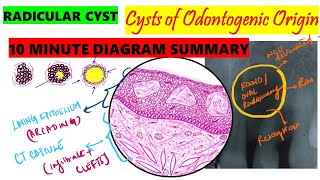 Radicular Cyst 10 MINUTE SUMMARY HISTOPATHOLOGY  Clinical features  Etiopathogenesis  Oral path [upl. by Aihtibat188]