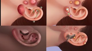 ASMR Ear piercing infection treatmentcleaning ear stone [upl. by Fendig]