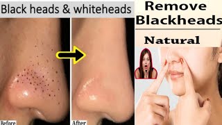 Get Rid Of Blackheads amp Whiteheads  Nose Blackhead Remove  Blackheads Khatam Karne Ka Tarika [upl. by Hasty]