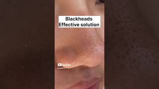 Blackheads amp Whiteheads Remedy skincare beauty beautytips [upl. by Lleira648]