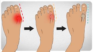 5 Effective Ways to Get Rid of Bunions [upl. by Gothart]