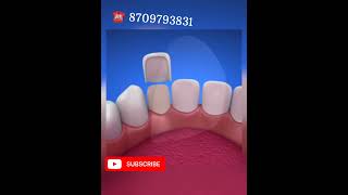 Dental Veneers Laminates for Bollywood Smile yt shorts dentalveneerssmile dentist in Patna [upl. by Amalea]