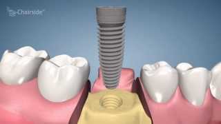 Dental Implant Procedure  One Stage [upl. by Etnad62]