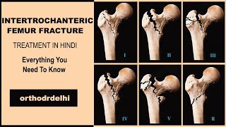 INTERTROCHANTRIC FRACTURE FEMUR IN HINDI proximal femur fractures IN HINDI [upl. by Garin459]