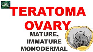 TERATOMAOVARY Ovarian Tumor Series Part 5 [upl. by Condon]