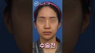 노즈랩의원 수술전후 beforeandafter 코성형 비개방코성형 noselab [upl. by Durman]