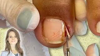 A UNHA ENCRAVADA  THE INGROWN NAIL [upl. by Savanna]