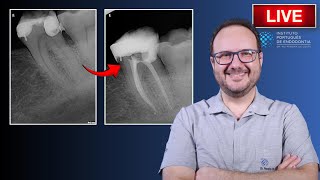 Endo Tx of 🦷37 with Irreversible Pulpitis amp Condensing Osteitis ▶️ Part 2  CASE164 [upl. by Aicilihp294]