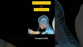 NG  Nasogastric  Tube Insertion Techniquen In Hindi ll RT Tube Insertion Procedure ll SG Pharma [upl. by Adyela960]