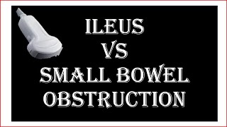 Ultrasound of ileus VS small bowel obstruction [upl. by Lamonica806]