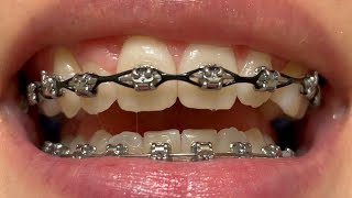 Adult Braces  20 Month Update [upl. by Learrsi]