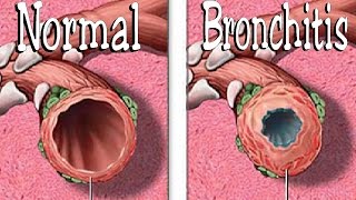 Chronic bronchitis  Symptoms of chronic bronchitis  Bronchitis treatment [upl. by Ycniuqal]