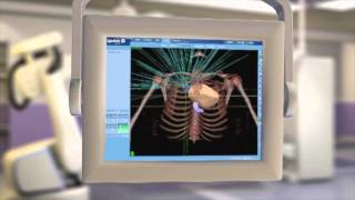 CyberKnife® Radiation Therapy What It Is amp How It Works [upl. by Luciano]