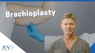 Brachioplasty Surgery Explained By Plastic Surgeon What is it Scars Recovery and More [upl. by Askwith]