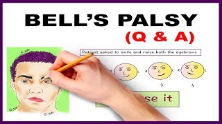 Bells palsy Upper and Lower Motor Neuron Lesions  Q amp A [upl. by Ydda]