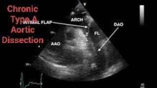 Chronic Type A Aortic Dissection CTAD Echocardiography post AVR [upl. by Nomra]