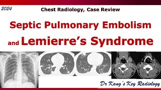 Septic pulmonary embolism and Lemierres syndrome [upl. by Hezekiah]