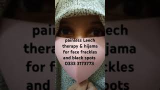 Painless hijama treatment for facefracklejhanyon k lye painless leech therapyour satisfied patient [upl. by Caylor]