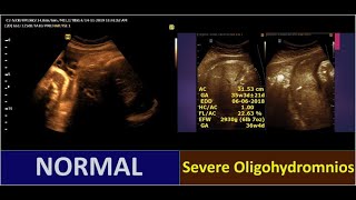 Severe Oligohydromnios  Comparison between Normal and abnormal [upl. by Notsirt]